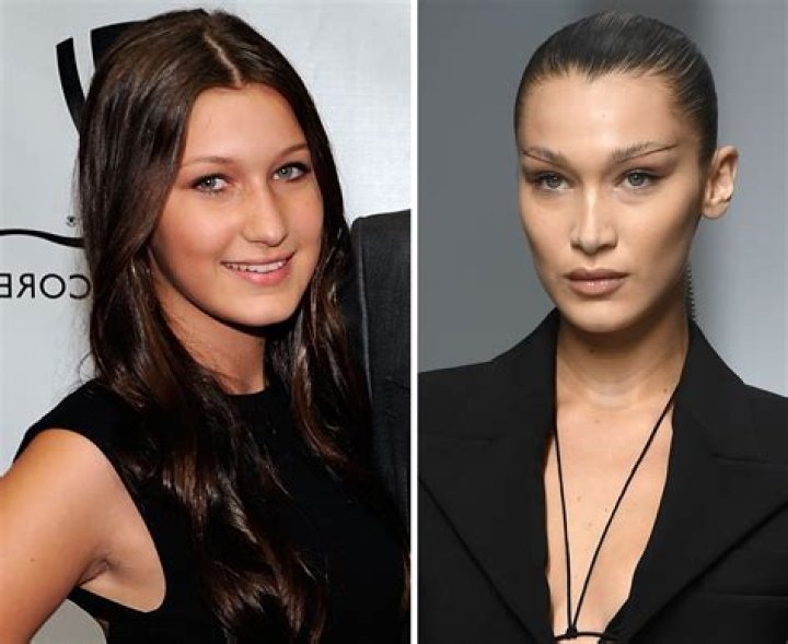 
Bella Hadid Before And After: Her Cosmetic Procedures Broken Down 