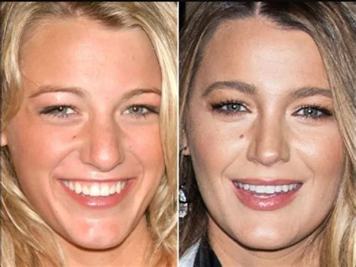 Blake Lively | Nose Job And Plastic Surgery Before And After