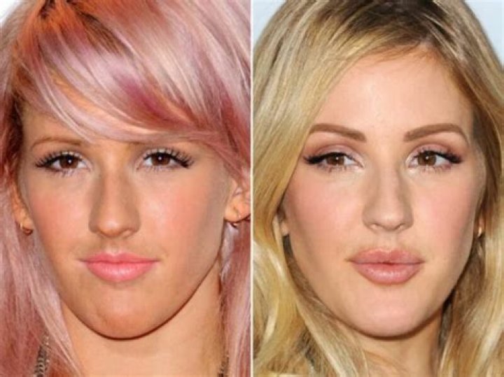 
Ellie Goulding Before and After Photos Hints at Plastic Surgery But The Singer Denies It 