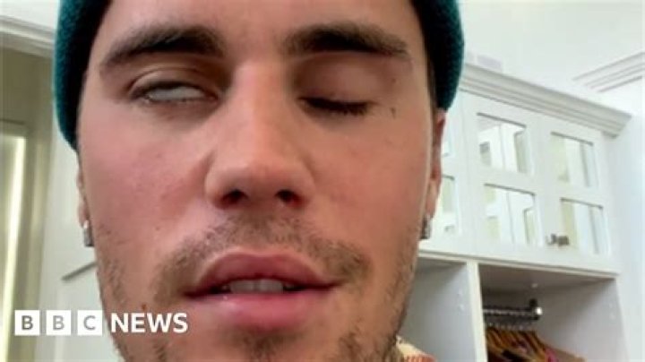 
Justin Bieber Has Facial Paralysis, Reveals Ramsay Hunt Syndrome Diagnosis in Video Message 