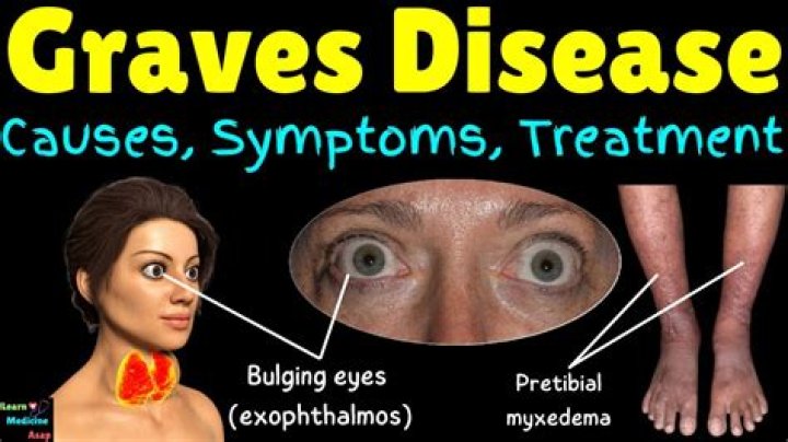 Karen Robinson Eyes Problems – Does She Have A Graves Disease?