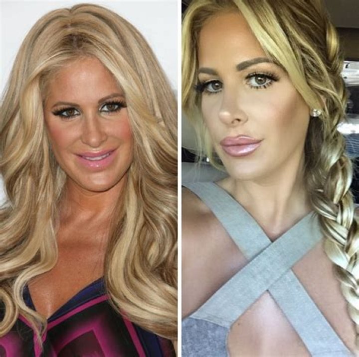 Kim Zolciak-Biermann Before Surgery Pics, Nose Job Age And Partner