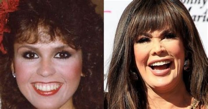 Marie Osmond Without Makeup Look: Plastic Surgery Before And After