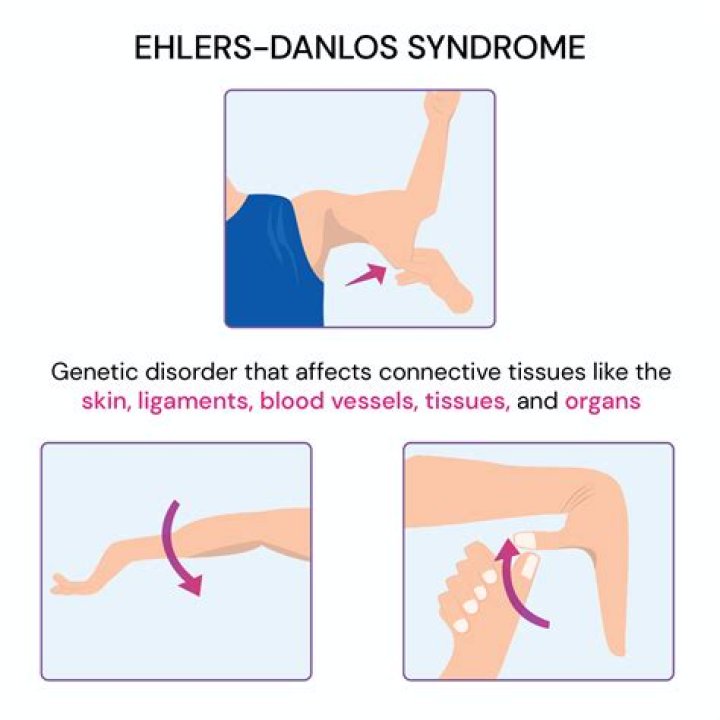 
What Condition Does Yvie Oddly Have? Ehlers–Danlos Syndrome Type 3 Illness Details 
