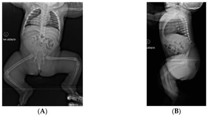 Zion Clark Talks Anatomy and Walking With His Hands, This Is How Caudal Regression Syndrome Works